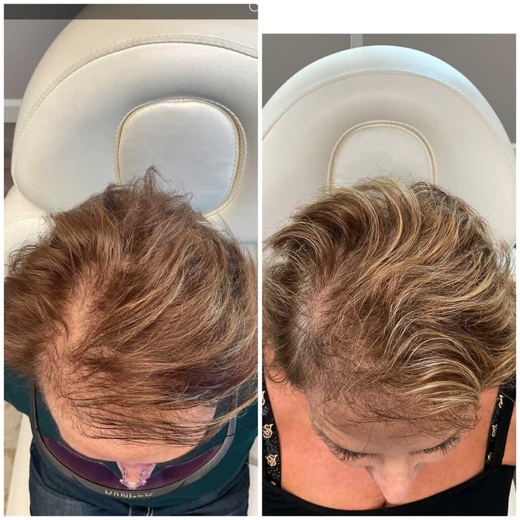 Regenicel Aesthetics Before & After
