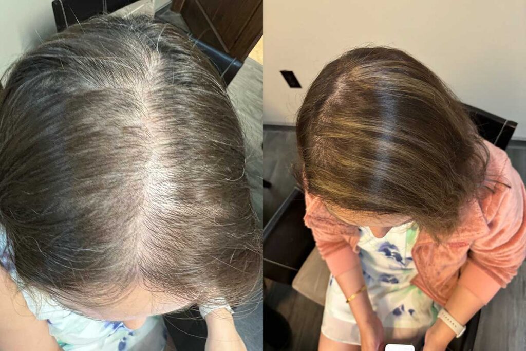 Regenicel Aesthetics Before & After