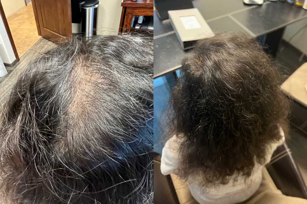 Regenicel Aesthetics Before & After