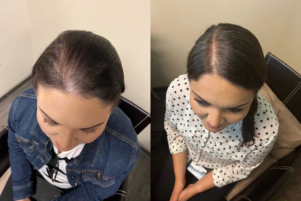 Regenicel Aesthetics Before & After