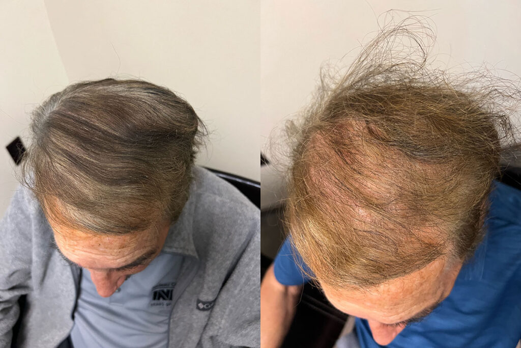 Regenicel Aesthetics Before & After