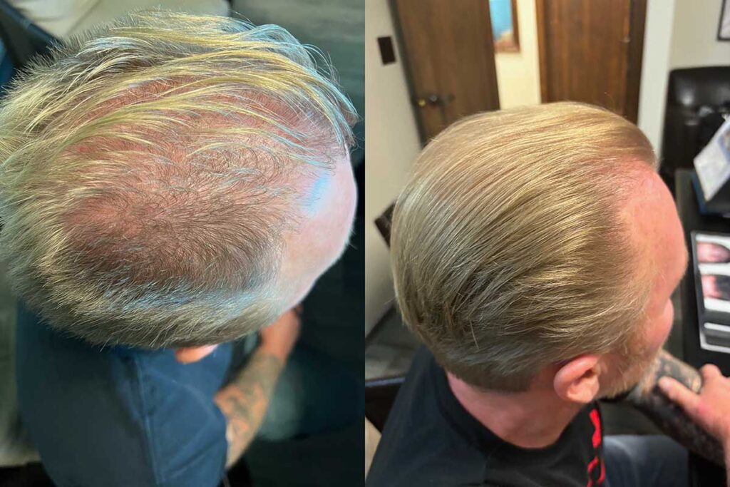 Regenicel Aesthetics Before & After