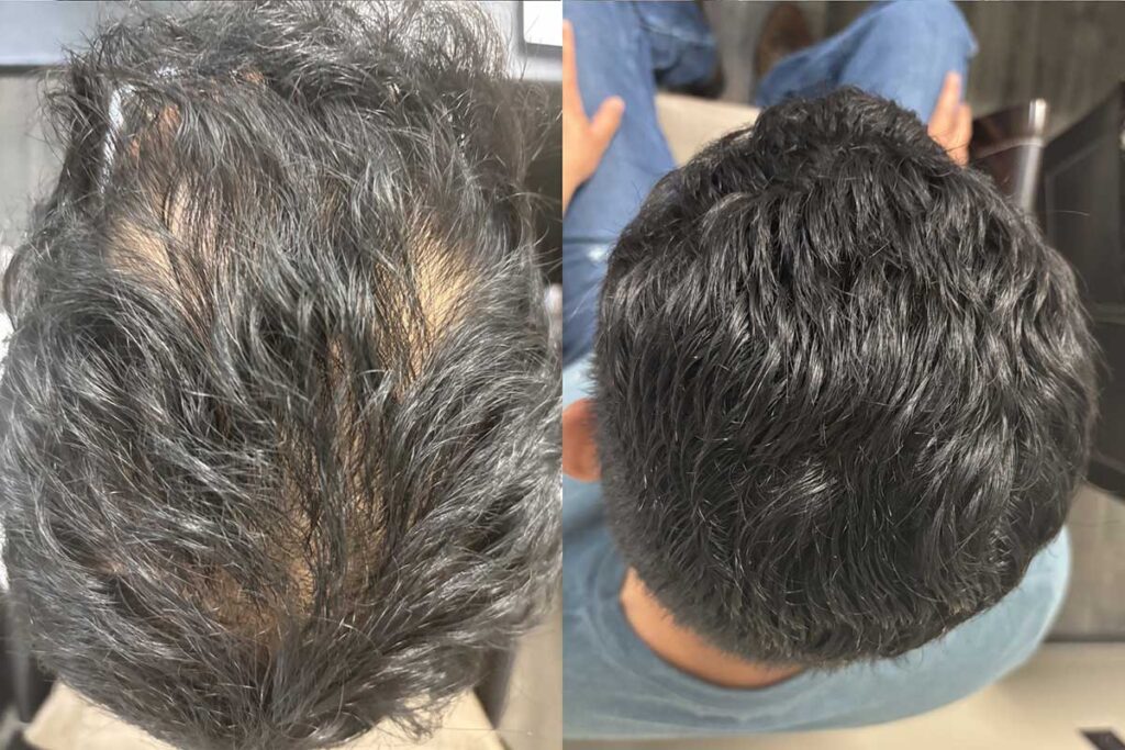 Regenicel Aesthetics Before & After