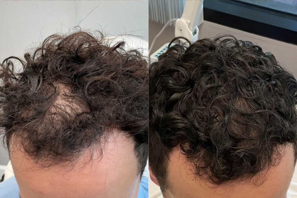 Regenicel Aesthetics Before & After